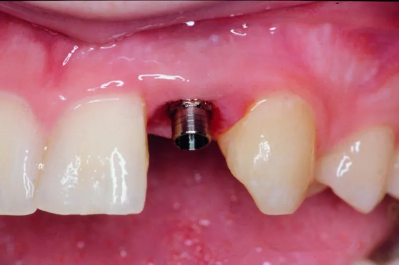 Implantat inden krone