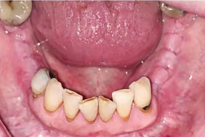 Medicinrelateret osteonerkrose