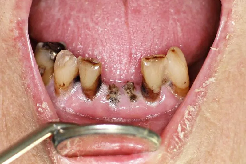 Strålerelateret caries