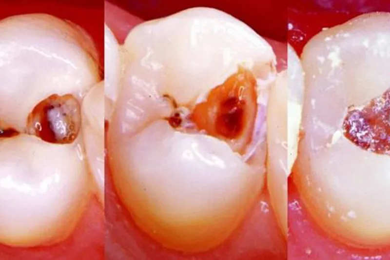 Caries collage