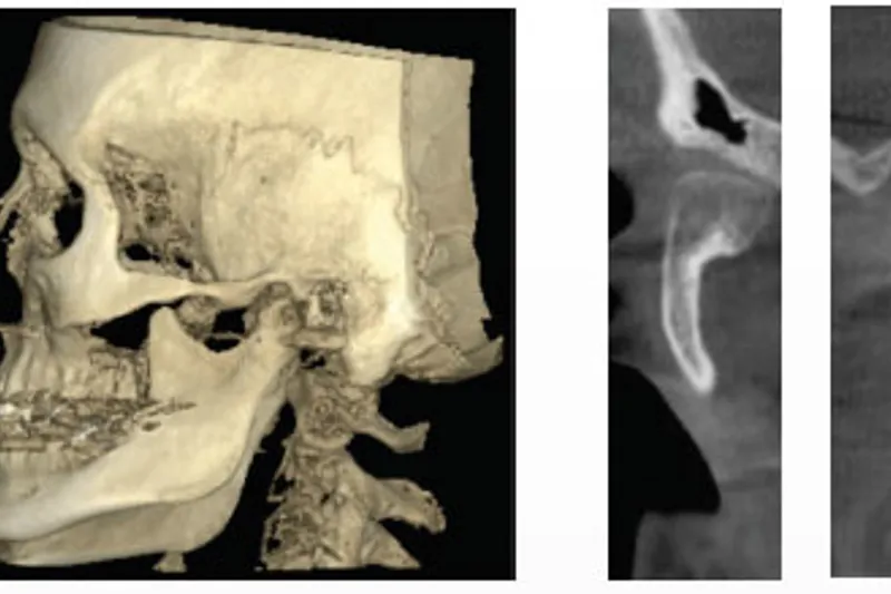 Hemimandibulaer Hyperplasi Tb
