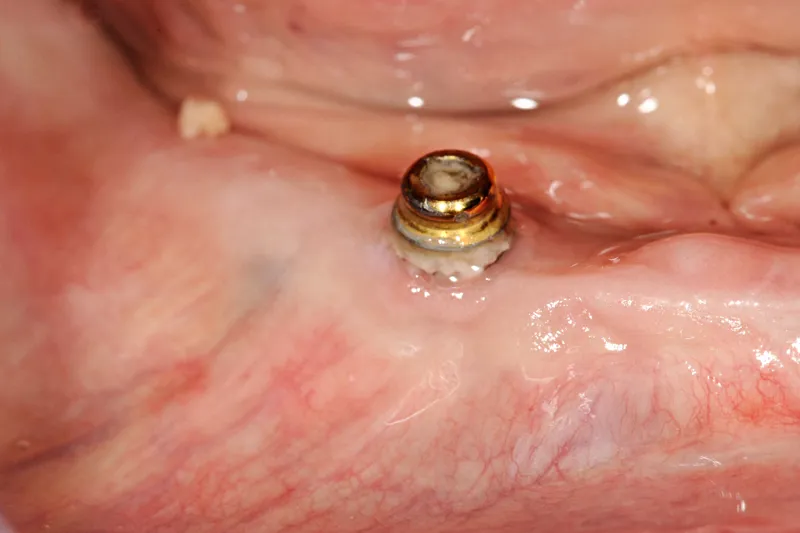 A753 Parodontitis og periimplantitis blandt ældre på institution (1)