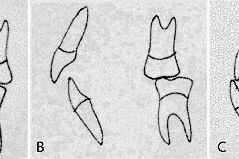 A749 Morfologisk okklusion (1)