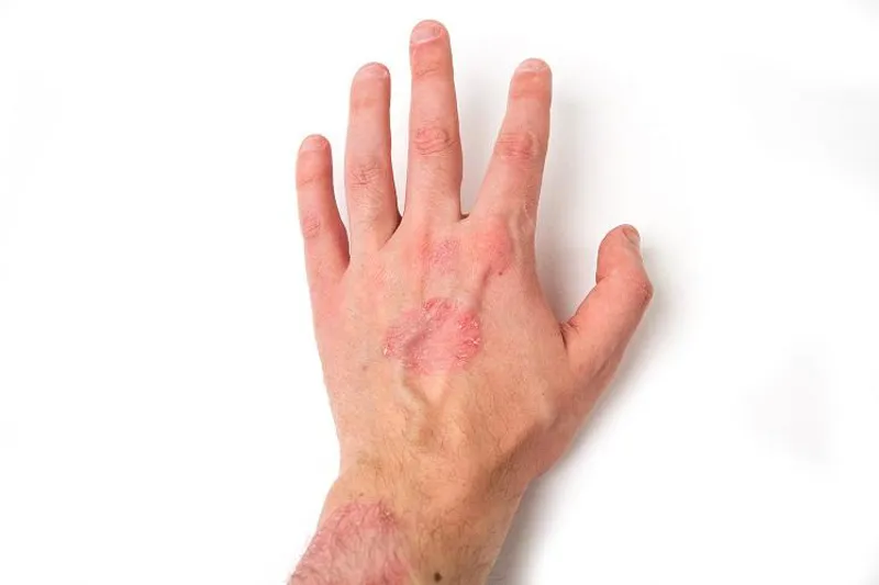 Psoriasis