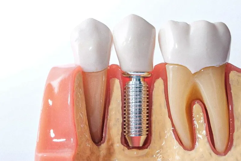 Implantat