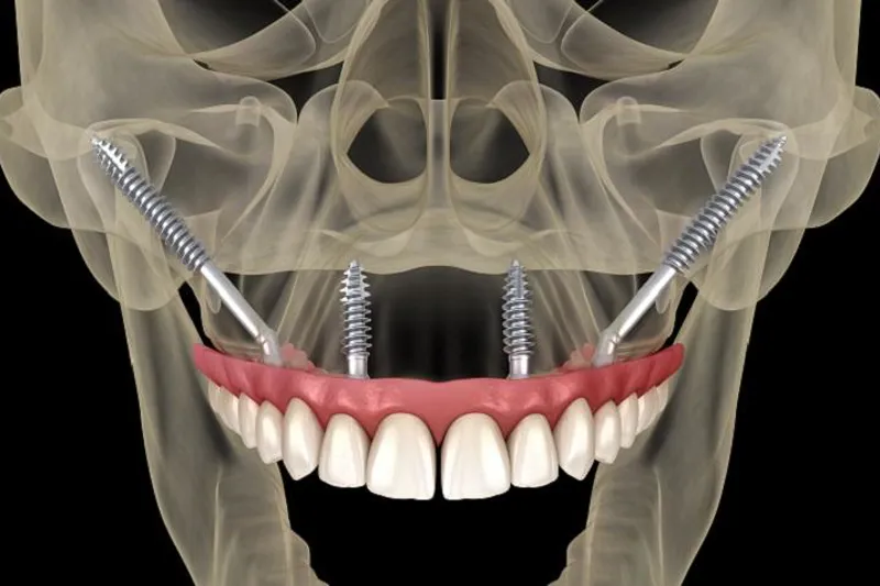 Implantat illu