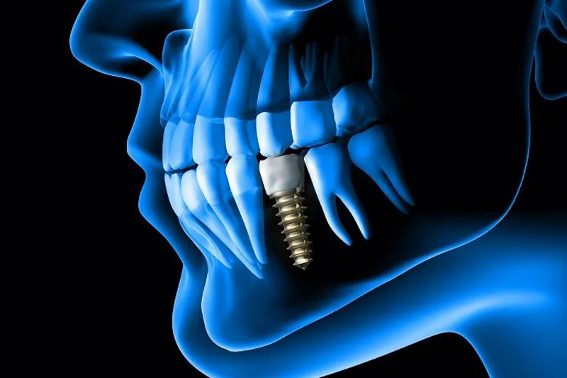 Implantatkirurgi