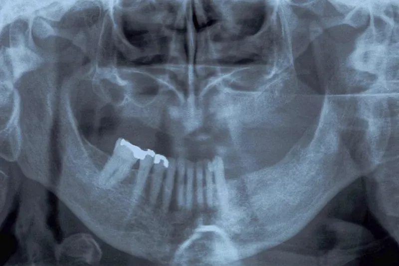 Oversigtsrøntgen diffus osteolyse