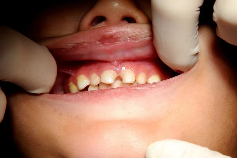 Tandbehandling børn