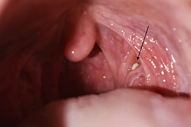 A762 Tonsillae palatinae (1)