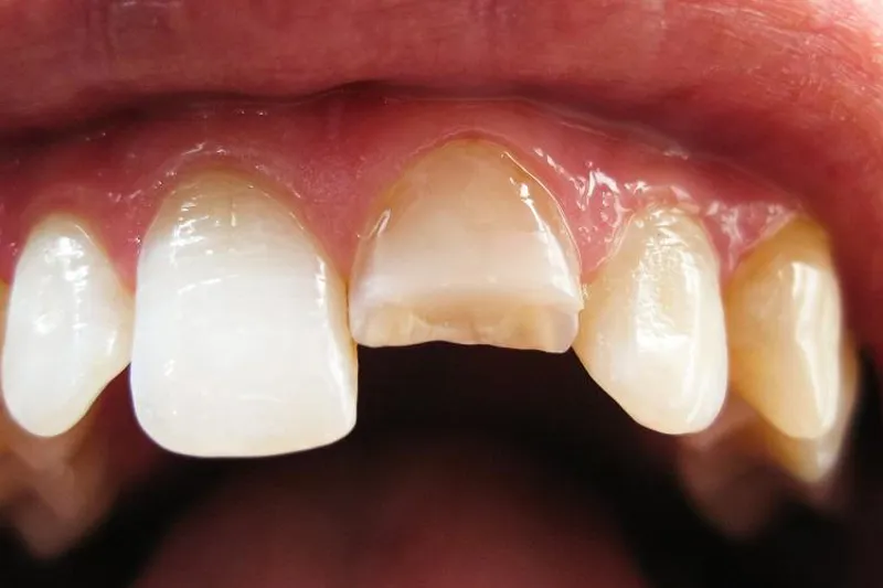 Horisontal rodfraktur