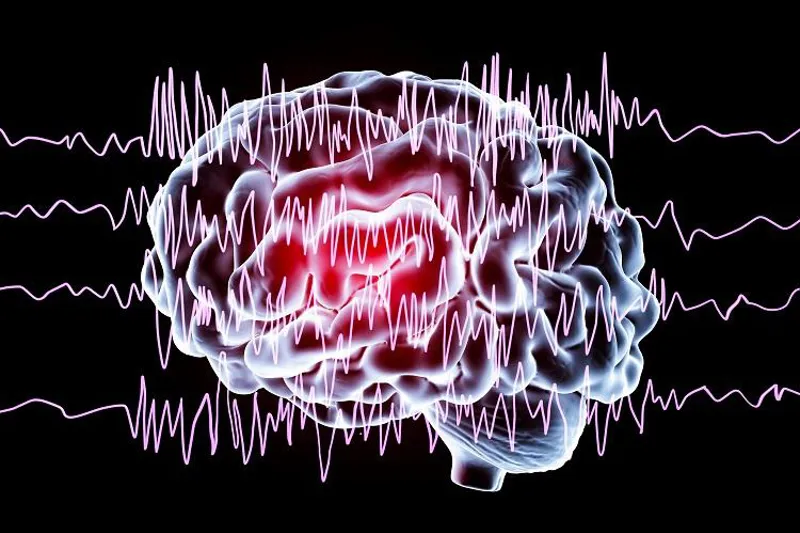 Epilepsi