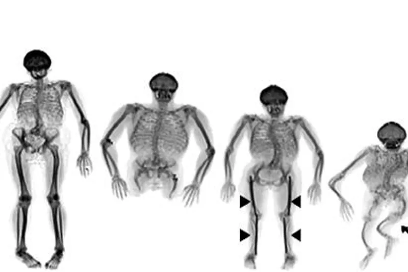 Osteogenesis (OI)