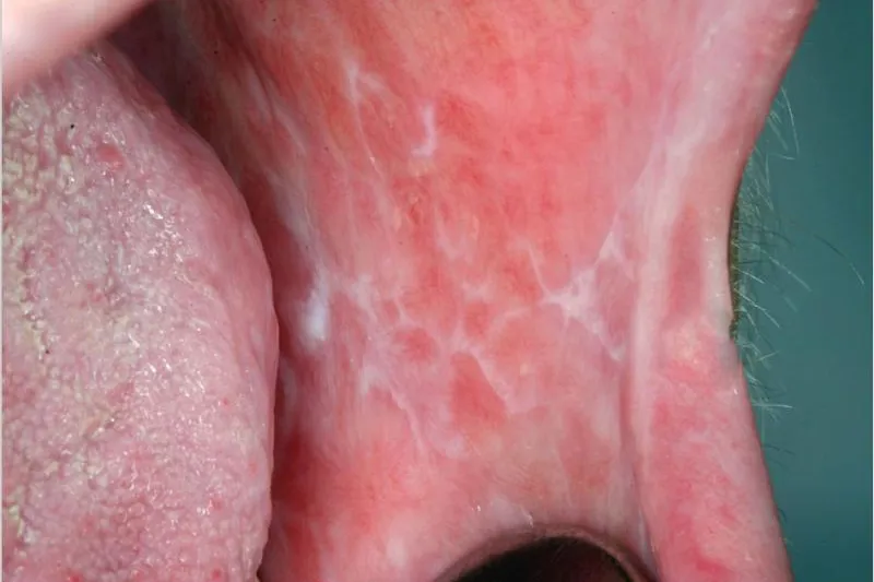Oral lichen planus