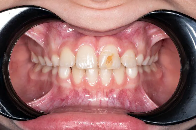 Skader på permanente incisiver