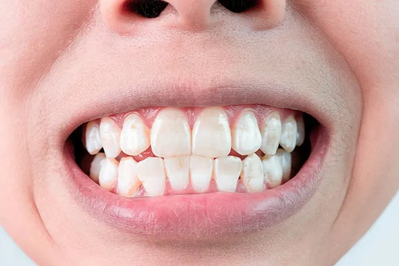 White spot lesions