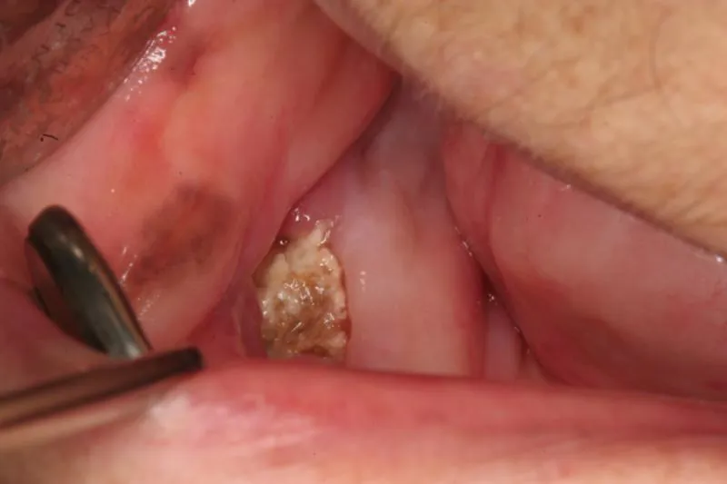 Oral cancer