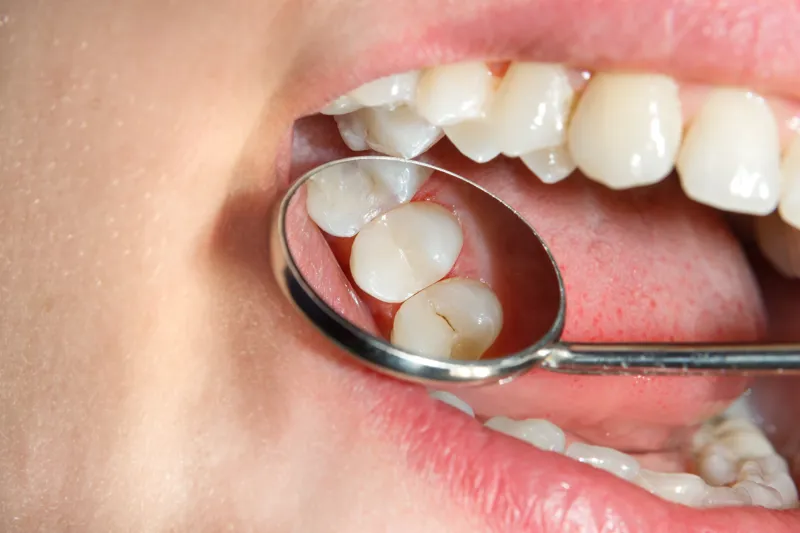 Caries fyldning revne i tand