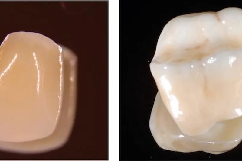 Posteriore broer af zirkonia og metalkeramik har samme overlevelsesrate