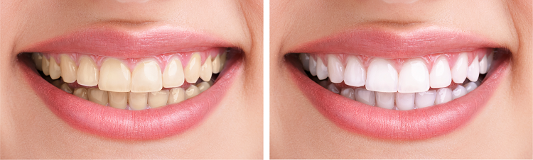 Anvendelse nød grill Gør-det-selv tandblegning kan skade mund og tænder | Tandlægebladet